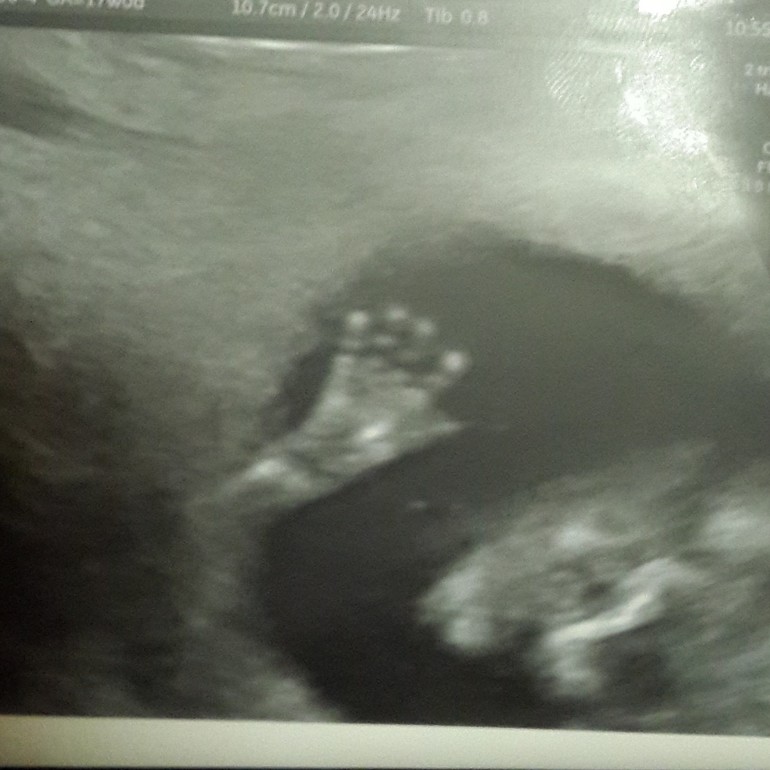 Подарочек на Новый Год))))18 неделя