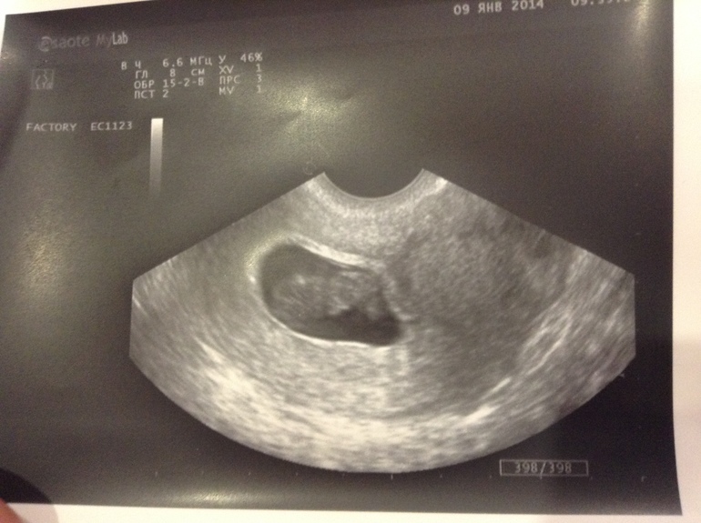 Узи 9-10 неделя