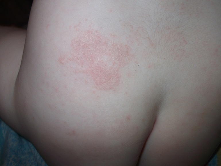 здравствуйте. подскажите что это может быть за сыпь?
