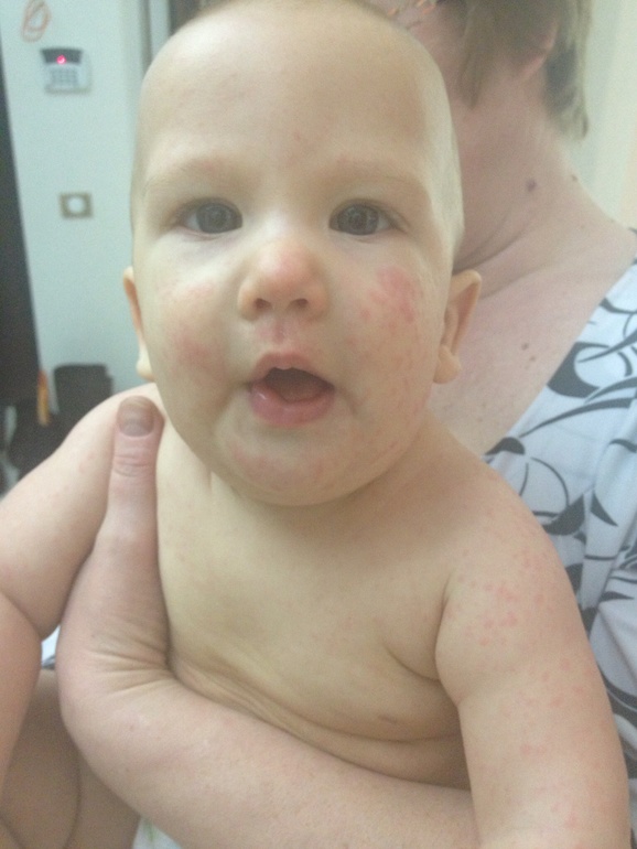 Ужасные высыпания...