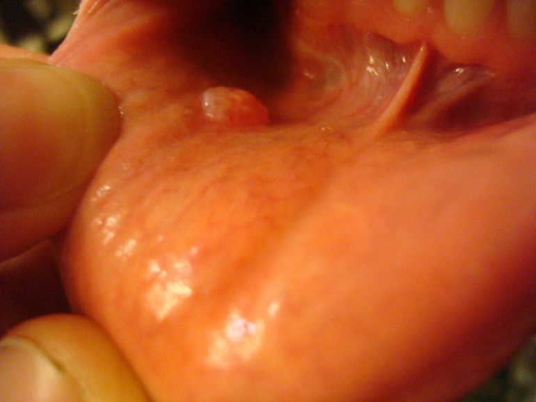 Бородавка на слизстой или вирус такой