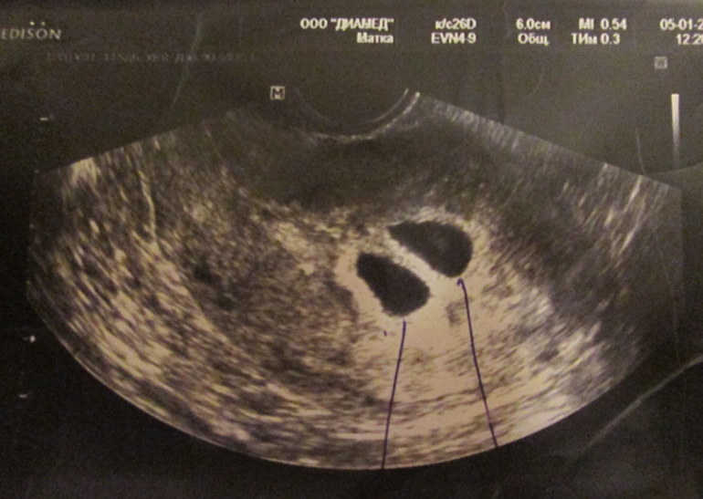 Мы ждем двойное ЧУДО!!!