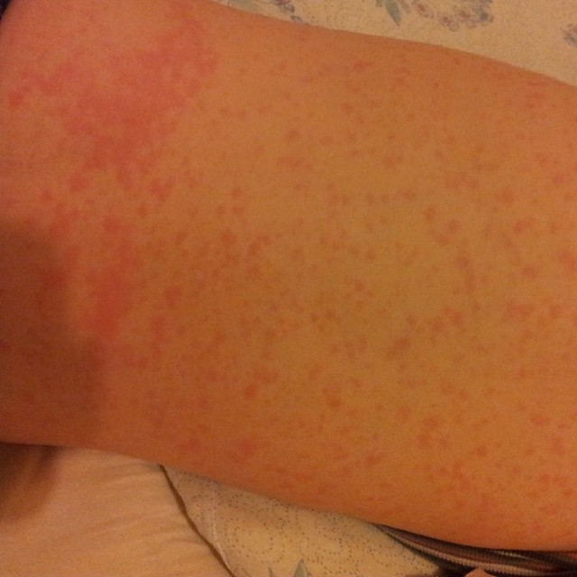 Аллергия или что?