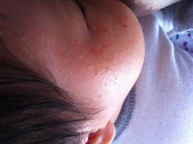 Сыпь на лице!!! Посоветуйте что нибудь!