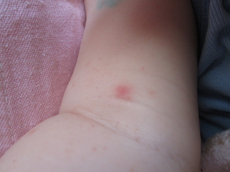 Что за сыпь???