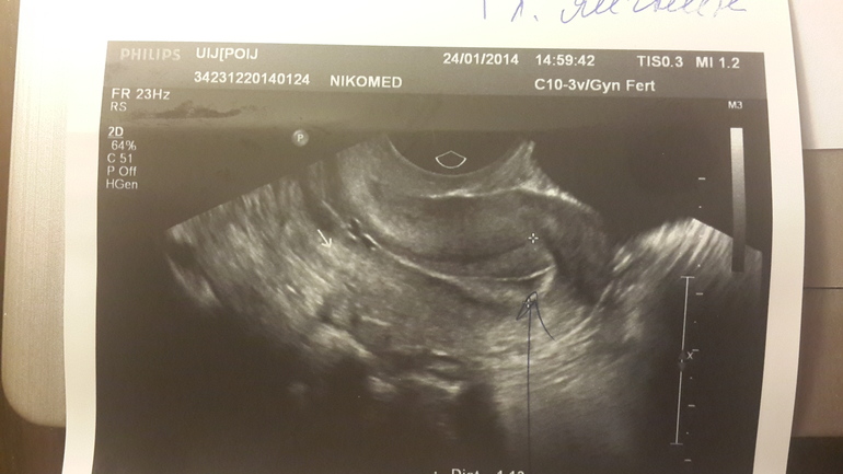 Девочки, кому ставили ЭНДОМЕТРИОЗ матки!?