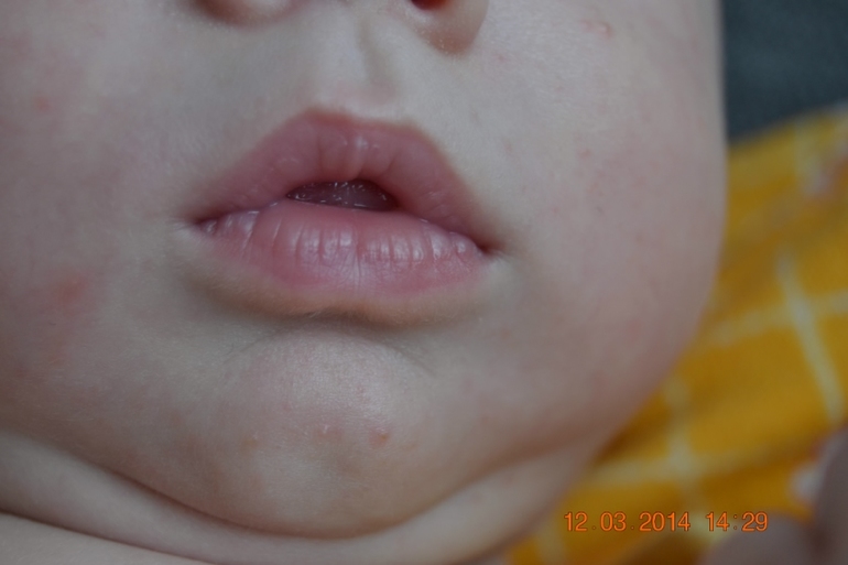 Странная сыпь!!