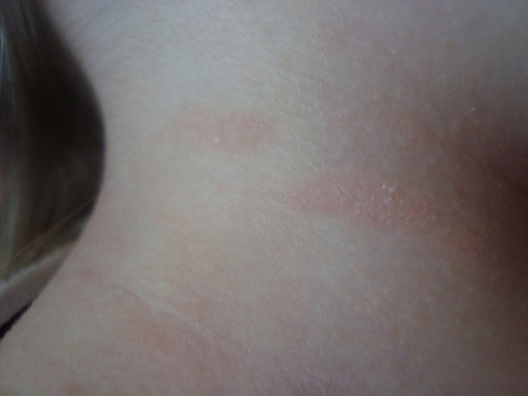 ну вот такие пятна У Шушки