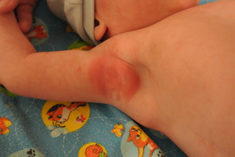 Аллергия ли это?