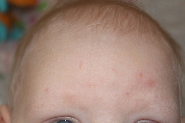 Сыпь у ребенка и красные пятна (фото)