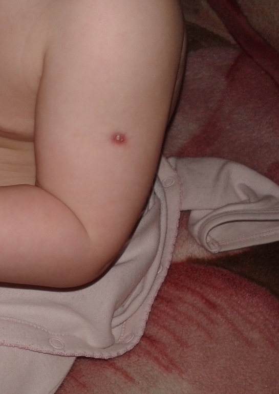 Долго не заживает БЦЖ