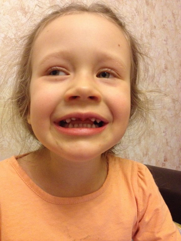 Повреждение зубной эмали у ребенка: причины и способы укрепления эмали