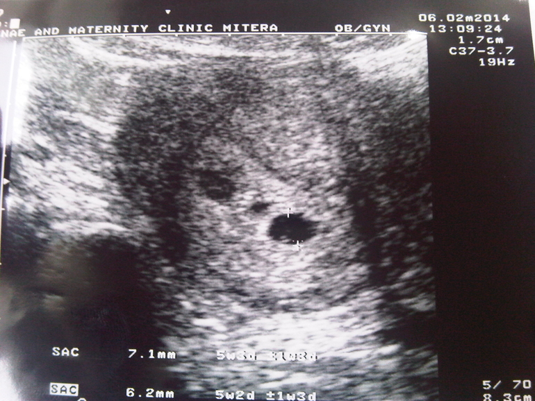 Экспертное УЗИ беременной до 10 недель (одноплодная и многоплодная беременности)