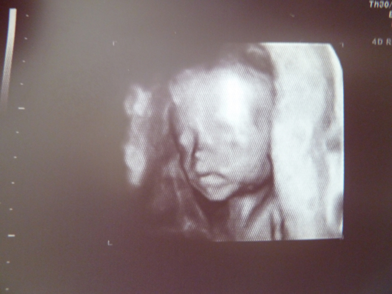 Повторное УЗИ