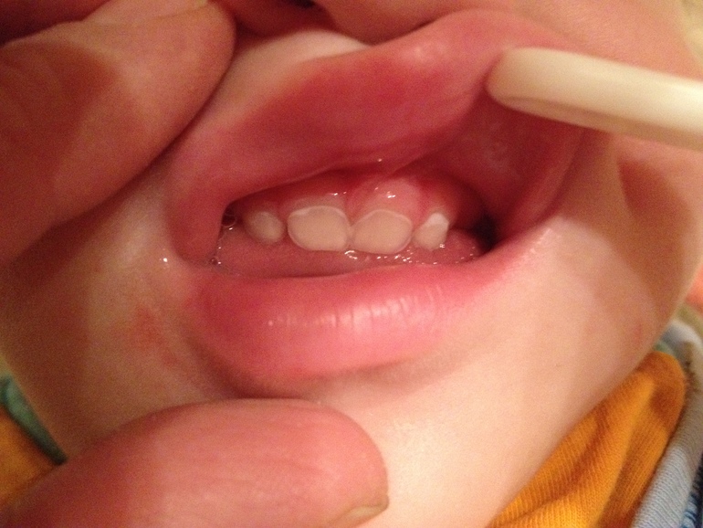 Начальная стадия кариеса? 1 год 7 мес