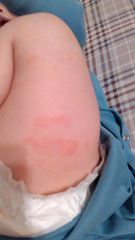 пятна на ножках