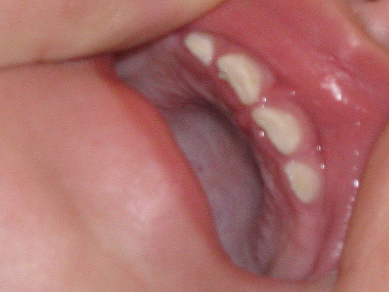 Что с зубами?