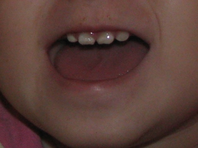 Что с зубами?