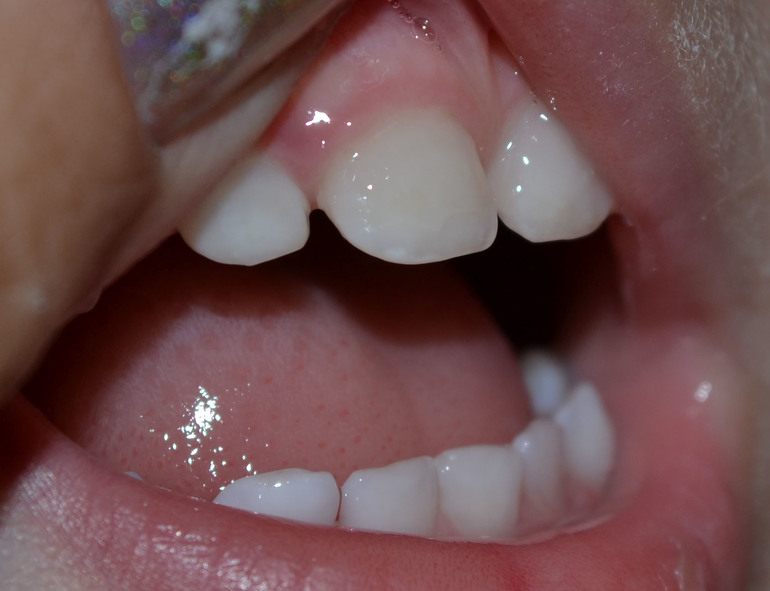 Скол эмали?