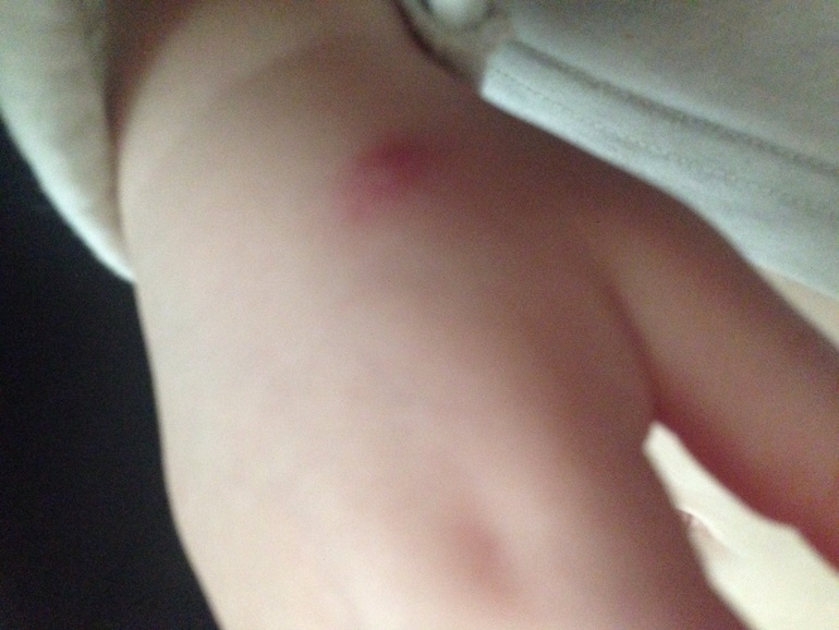 Ветрянка или нет?