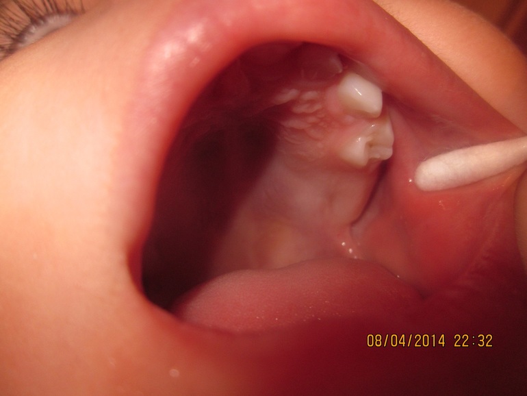 Лечение фиссурного кариеса