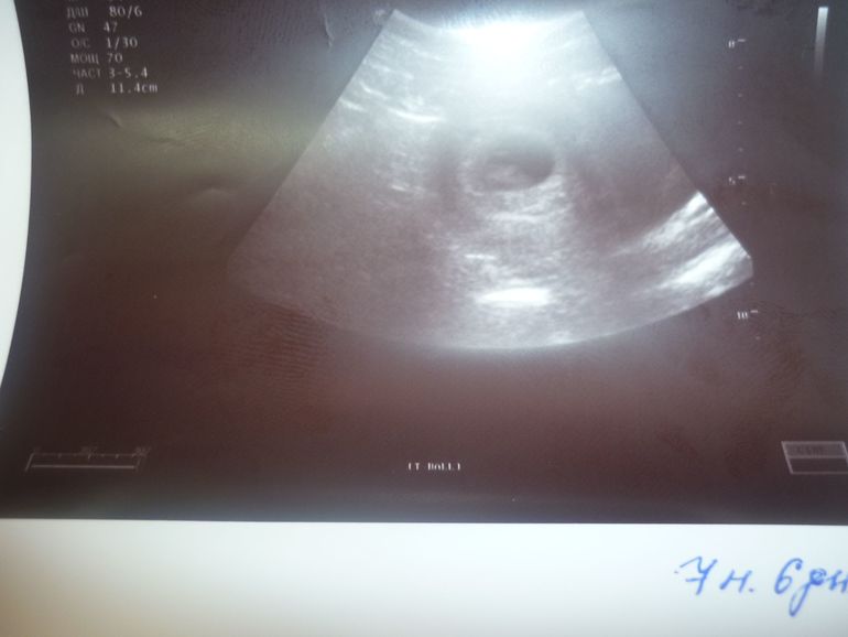 я слышала биение сердечка!!!!!АААААААААААААА