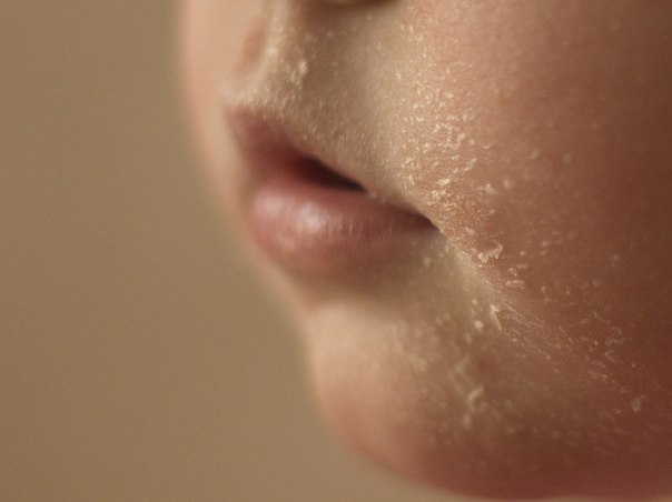 Аллергия на глютен и жив.белок..