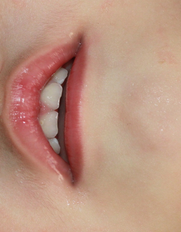 Это кариес?