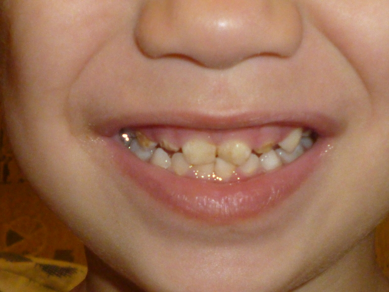 2,9 года, кариес, что целесообразно сделать?