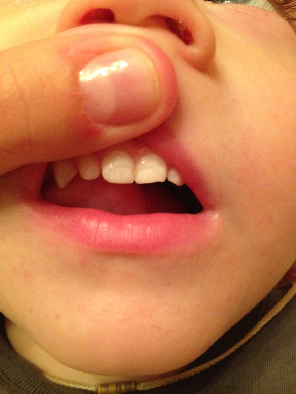 Налет или кариес?