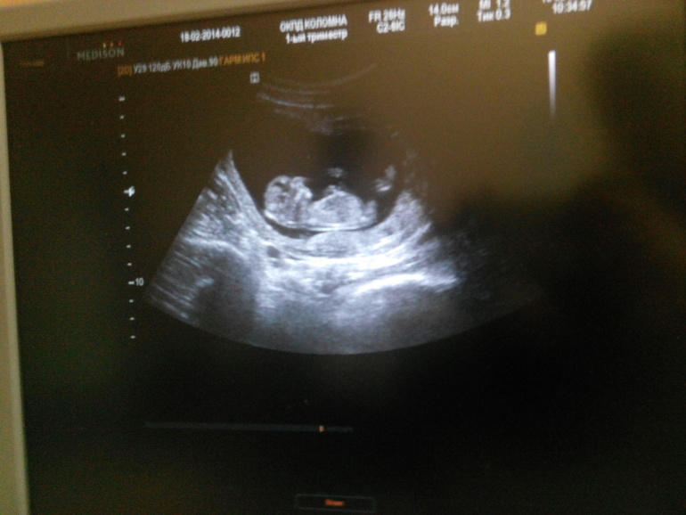 Первое УЗИ