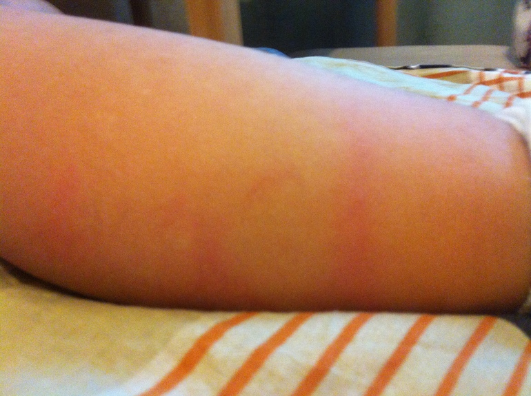 Пятна красные на ножке