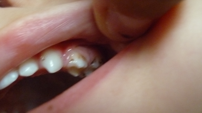 Налет на зубах