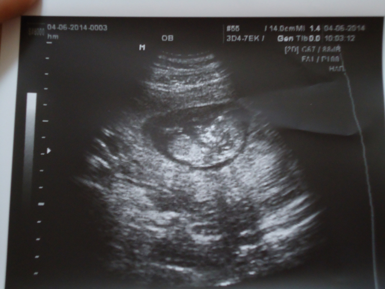 УЗИ 04.06.2014 (11 нед 6 дней)