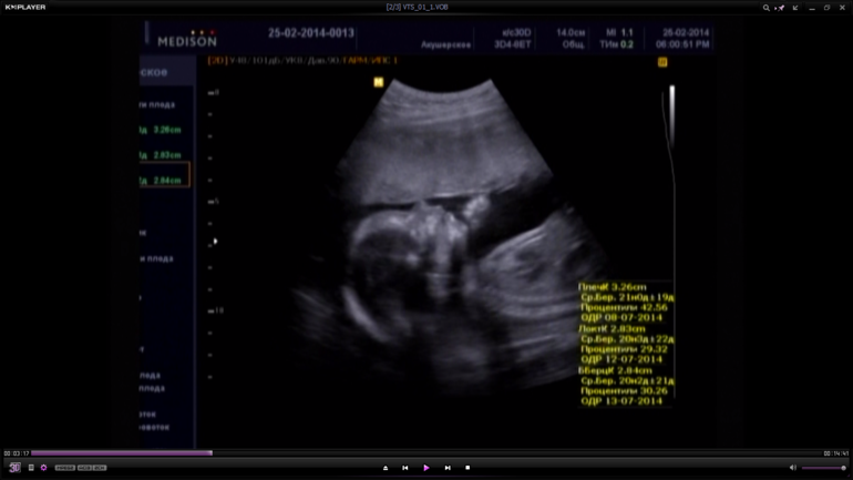 История моей Б, пишу на память для себя)))