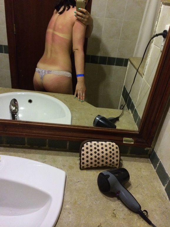 Спасасайте! Обгорела!