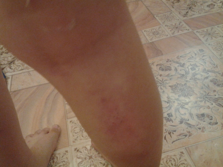 Чем заживить шрамы?