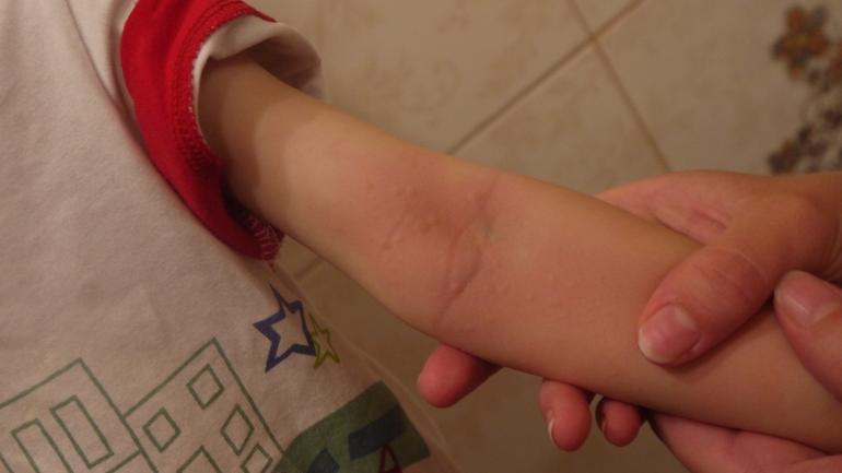 Здравствуй крапивница