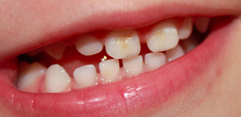 Бутылочный кариес.