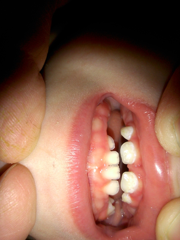 Налет и скол резца