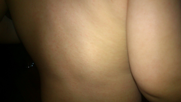 Аллергия или краснуха?