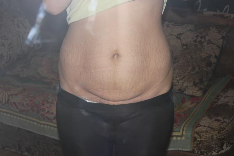 Девчат кто то, у кого такая складка смог избавиться от неё??