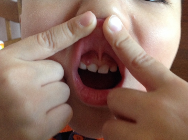 Пятнышко на десне