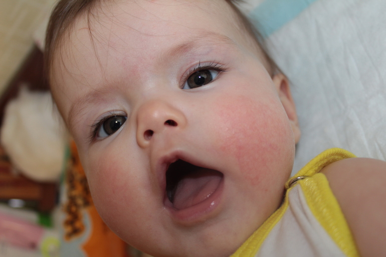 Девочки! Это диатез?