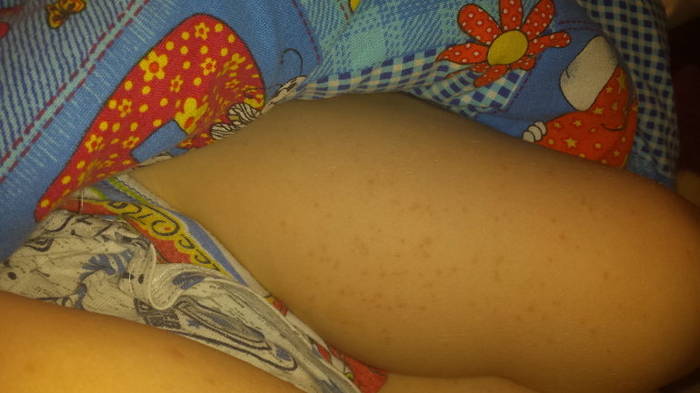 Странная сыпь