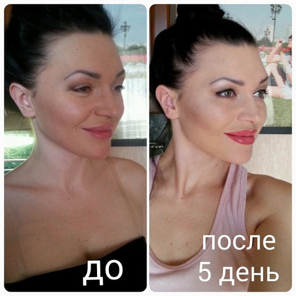 Фото губы после ботокса фото до и после