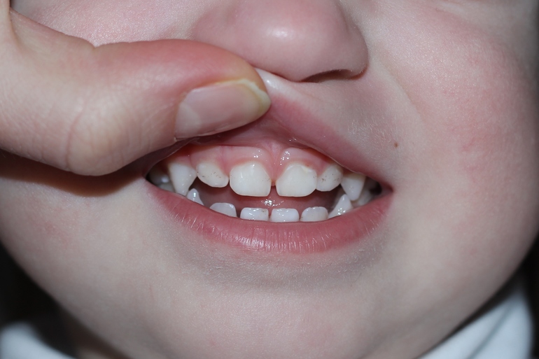 Кариес и открытый прикус