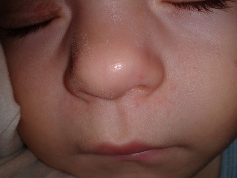 высыпание возле носа...