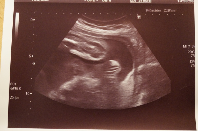 Сон мужа и результат узи.... )))))