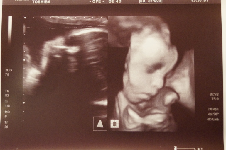 Сон мужа и результат узи.... )))))